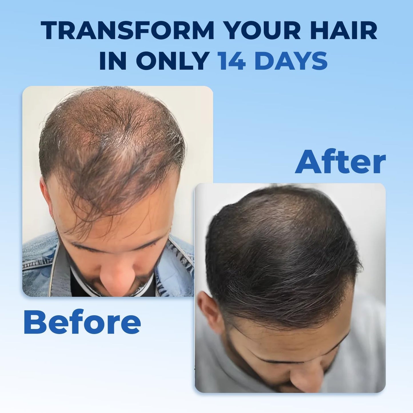 FEG Plus Hair Growth Spray - Rosemary Beard & Hair Growth Serum (50ml), Rosemary Extract Serum Hair Spray, Minoxidil 5% Solution for Hair Growth Booster, Revitalise Hair and Beard Regrowth